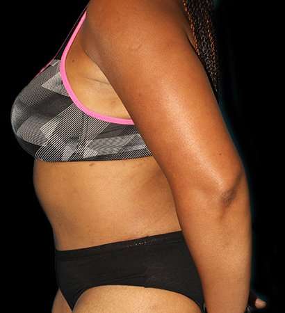 Tummy Tuck Before & After Patient #2302