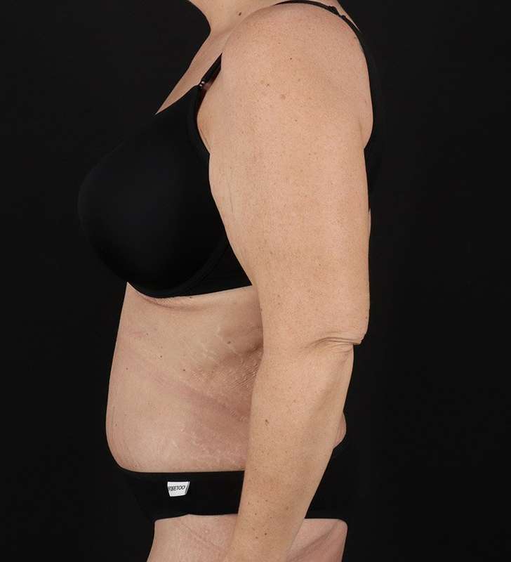 Tummy Tuck Before & After Patient #2326