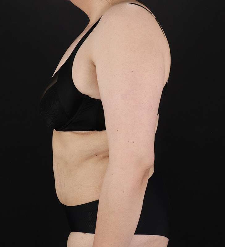 Tummy Tuck Before & After Patient #2339