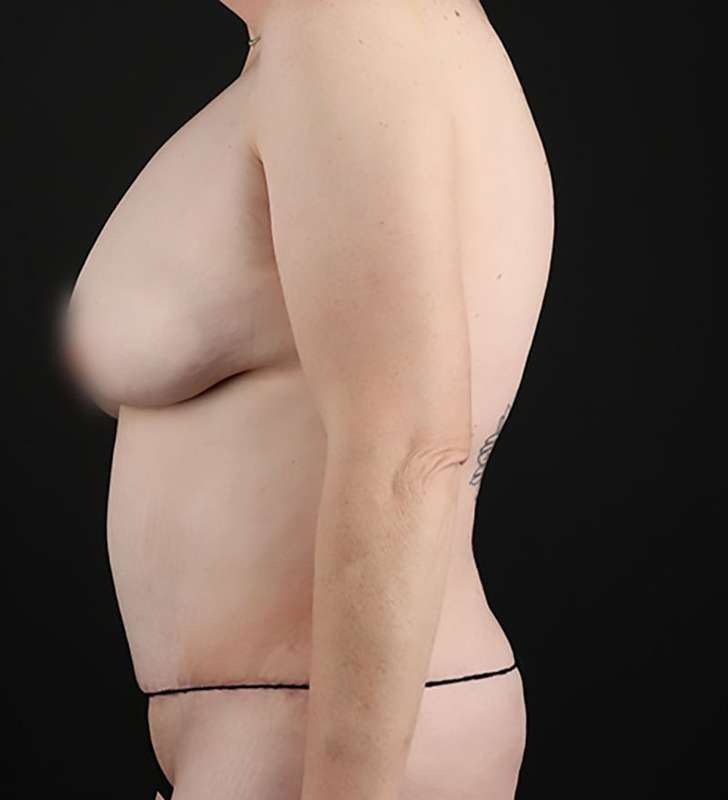 Tummy Tuck Before & After Patient #2363
