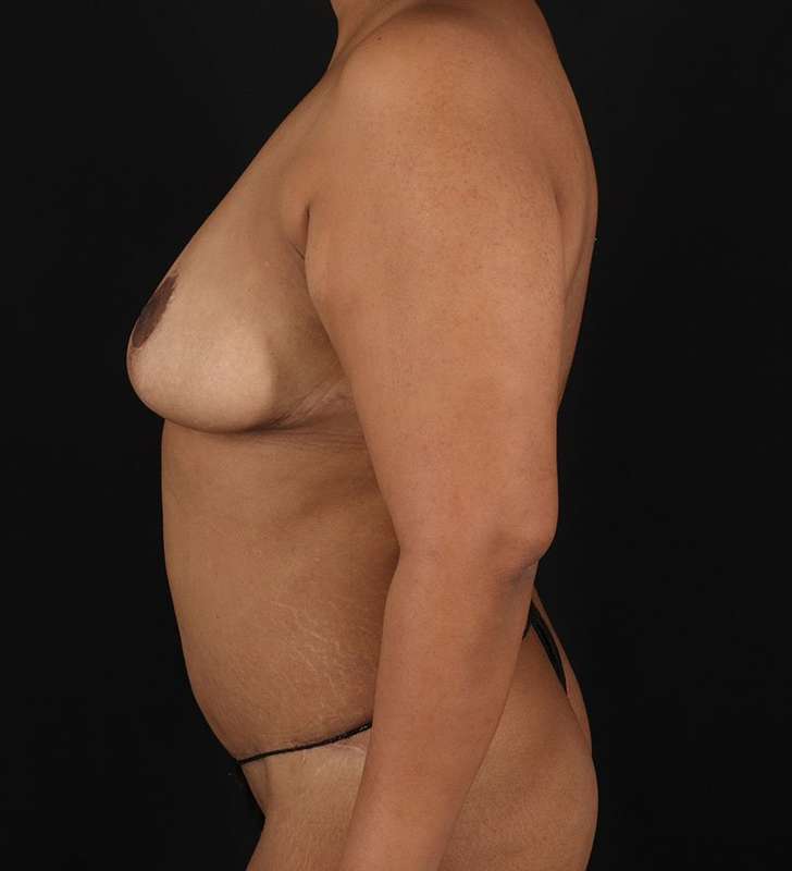 Tummy Tuck Before & After Patient #2389
