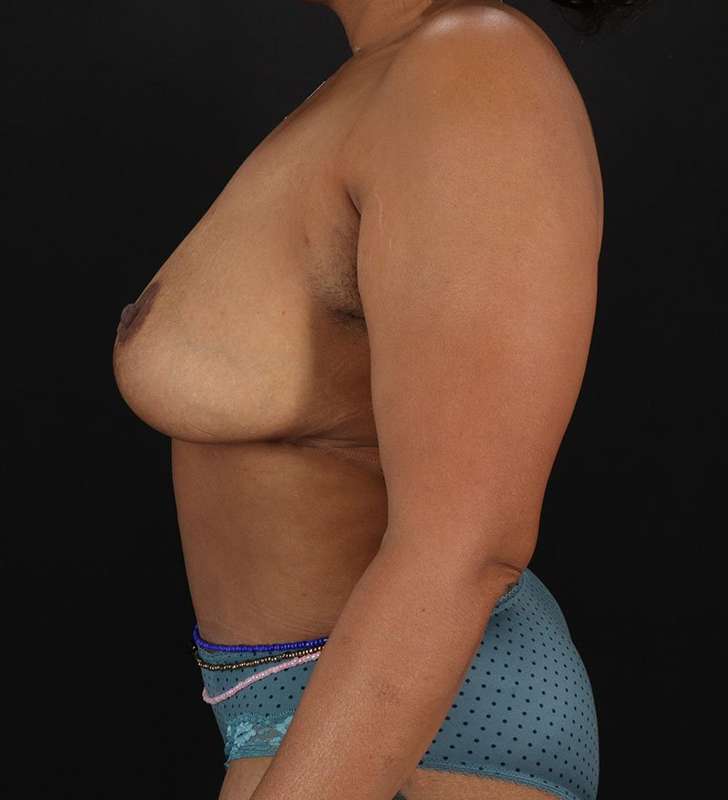 Tummy Tuck Before & After Patient #2402