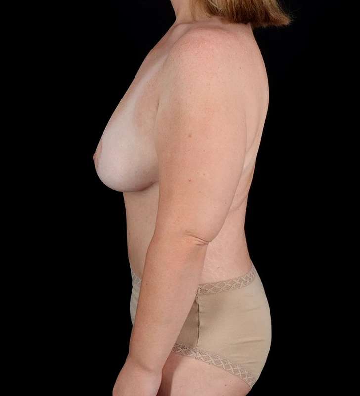 Tummy Tuck Before & After Patient #2413