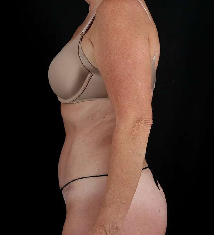 Tummy Tuck Before & After Patient #2435
