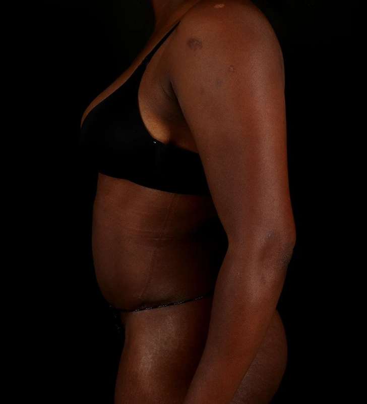 Tummy Tuck Before & After Patient #2448