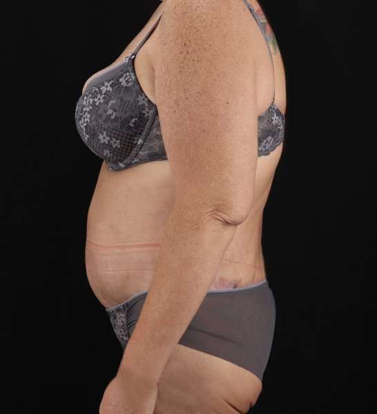 Circumferential Body Lift Before & After Patient #2509