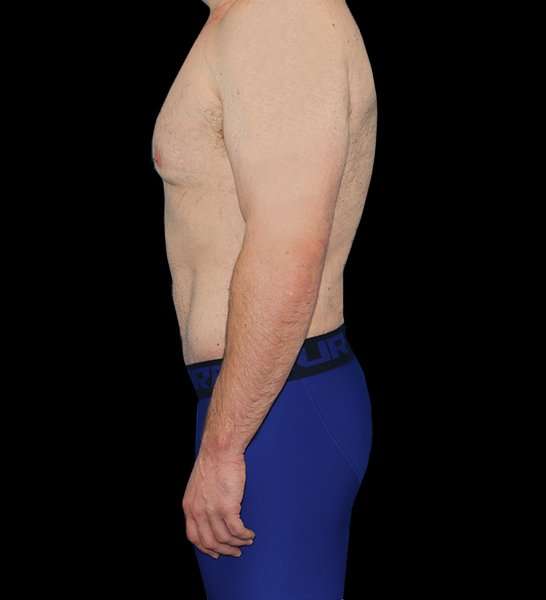 Circumferential Body Lift Before & After Patient #2522
