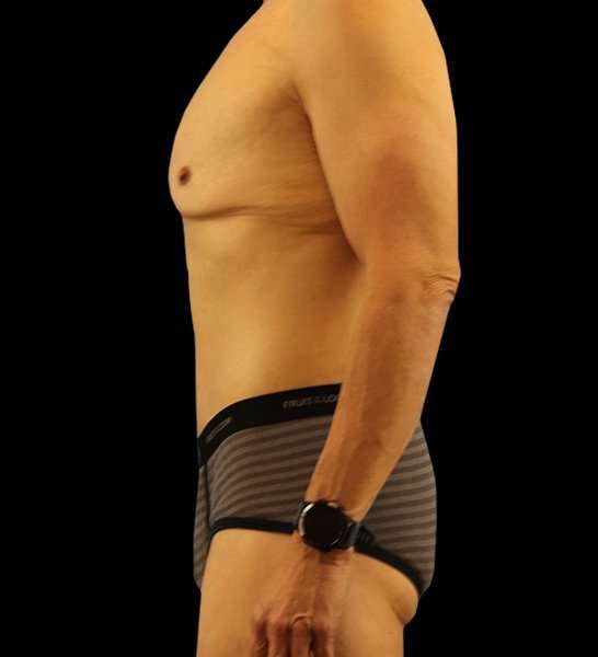 Circumferential Body Lift Before & After Patient #2535