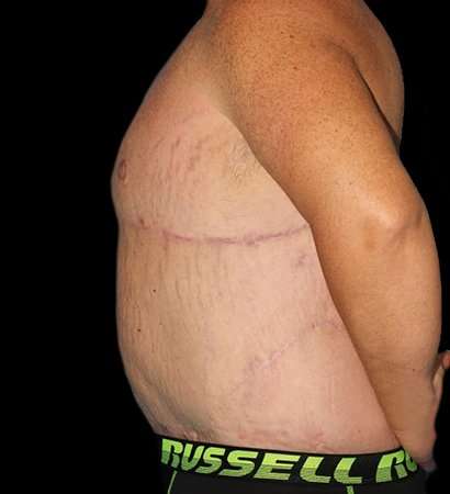 Massive Weight Loss Before & After Patient #5155