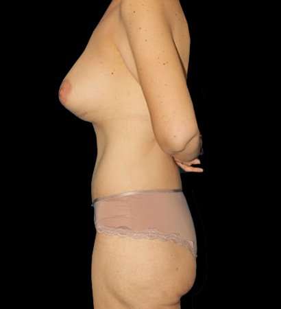 Circumferential Body Lift Before & After Patient #2559