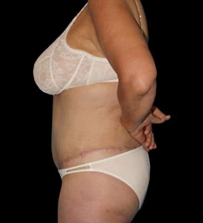 Circumferential Body Lift Before & After Patient #2572