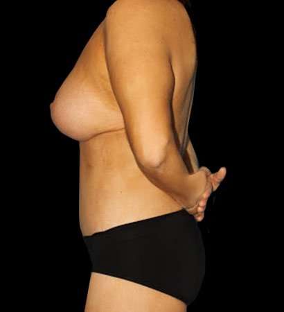 Circumferential Body Lift Before & After Patient #2585