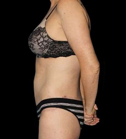 Circumferential Body Lift Before & After Patient #2598