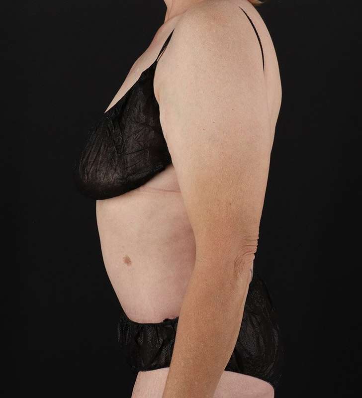 Circumferential Body Lift Before & After Patient #2624
