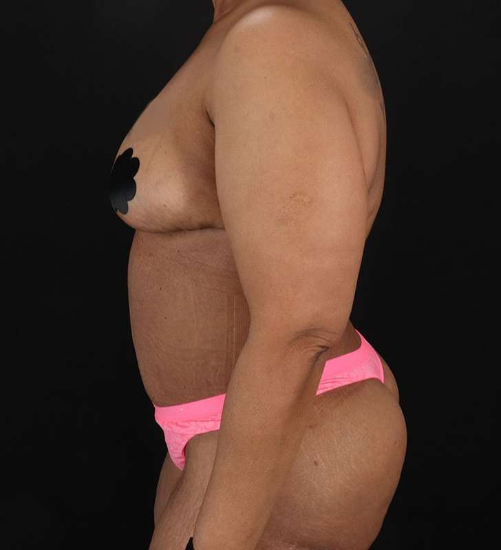 Circumferential Body Lift Before & After Patient #2637