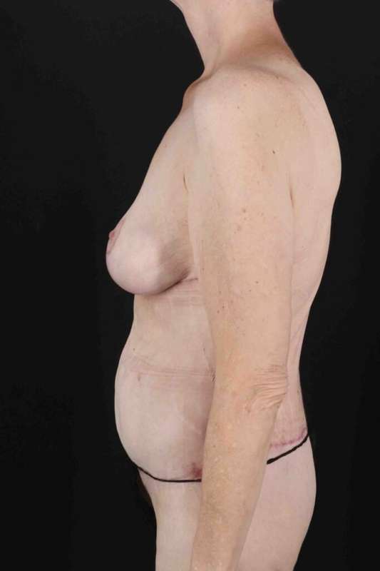 Circumferential Body Lift Before & After Patient #2663
