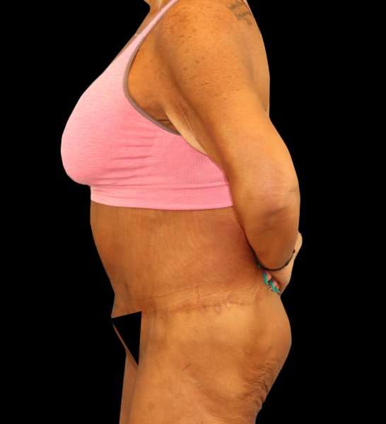 Fleur De Lis Circumferential Body Lift Before & After Patient #2674