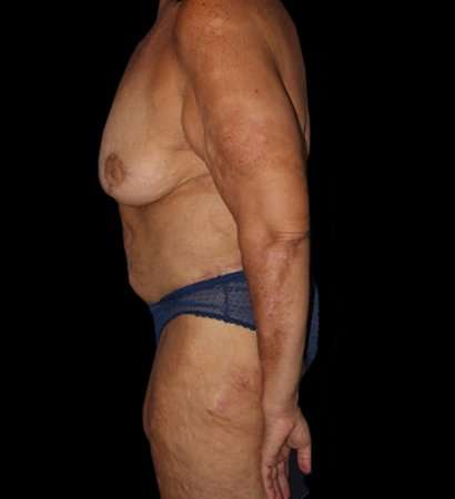 Fleur De Lis Circumferential Body Lift Before & After Patient #2685