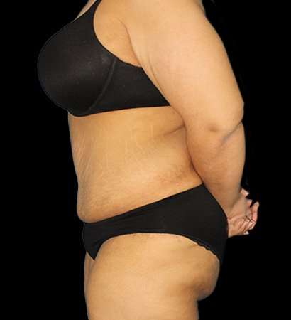 Fleur De Lis Tummy Tuck Before & After Patient #2703