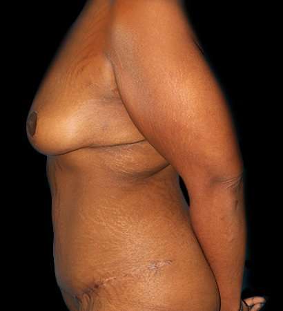 Fleur De Lis Tummy Tuck Before & After Patient #2714