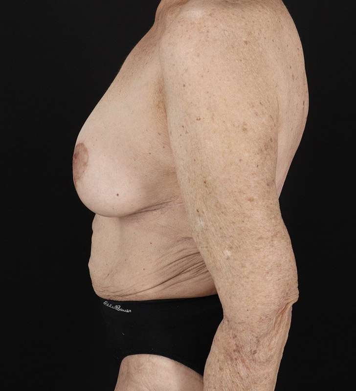 Fleur De Lis Tummy Tuck Before & After Patient #2727