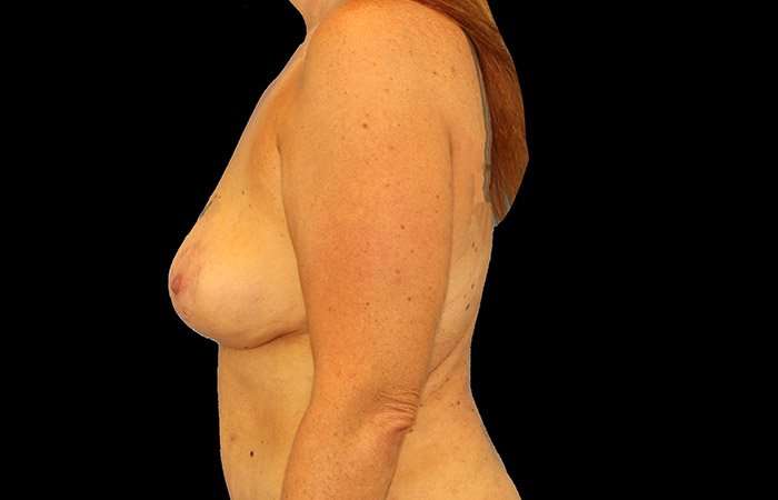 Breast Lift Before & After Patient #1094
