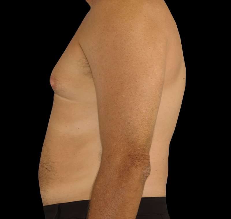 Liposuction Before & After Patient #2756
