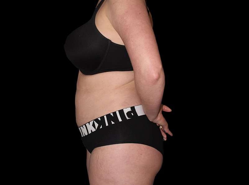 Liposuction Before & After Patient #2778