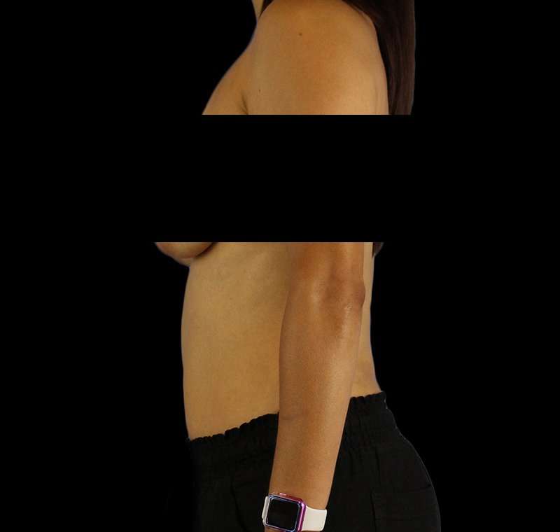 Liposuction Before & After Patient #2811