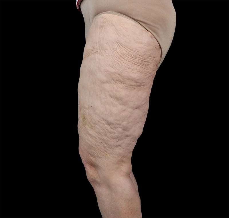 Liposuction Before & After Patient #2829
