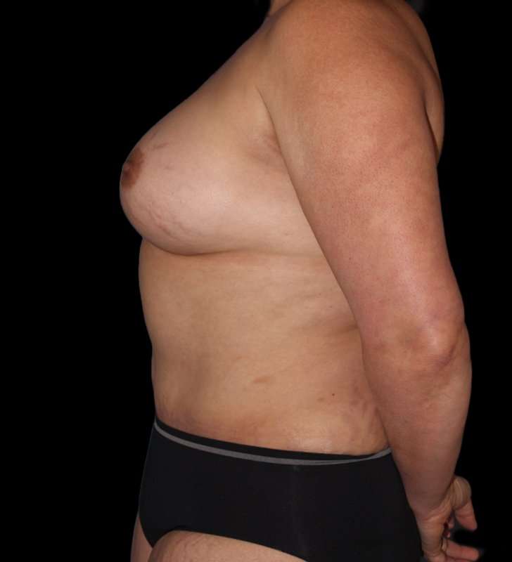 Mommy Makeover Before & After Patient #2878