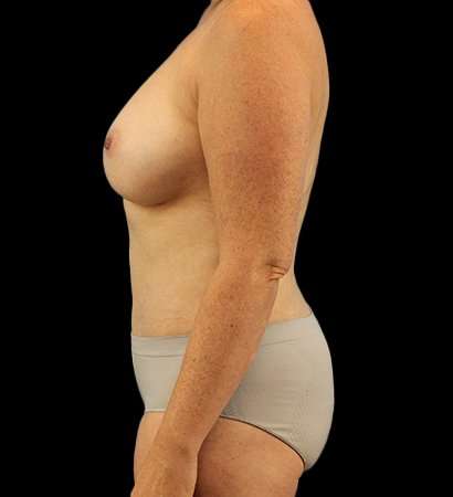 Mommy Makeover Before & After Patient #2974