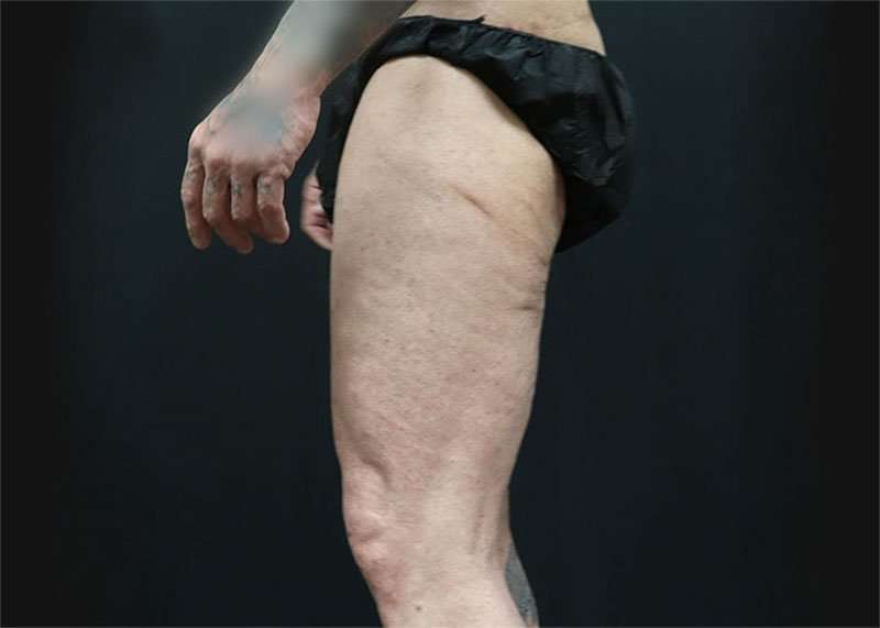 Thigh Lift Before & After Patient #2992
