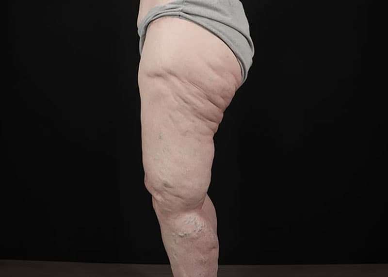 Thigh Lift Before & After Patient #3005