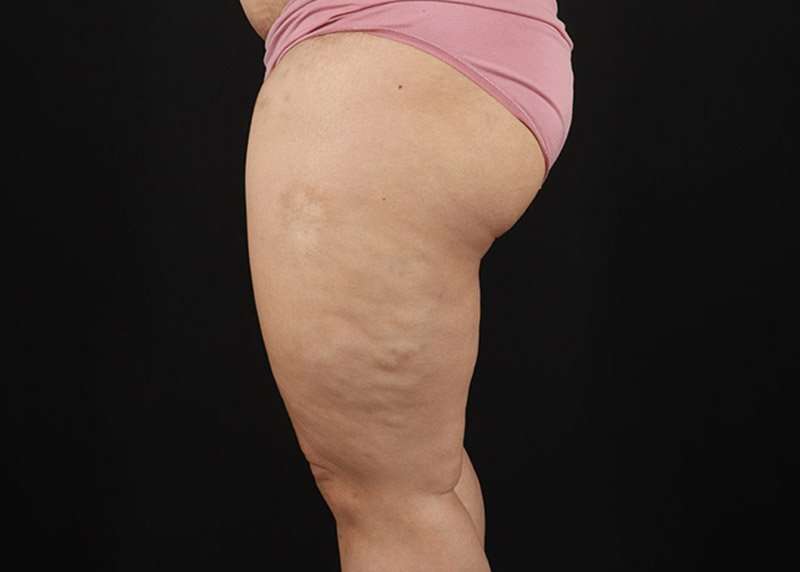 Thigh Lift Before & After Patient #3018