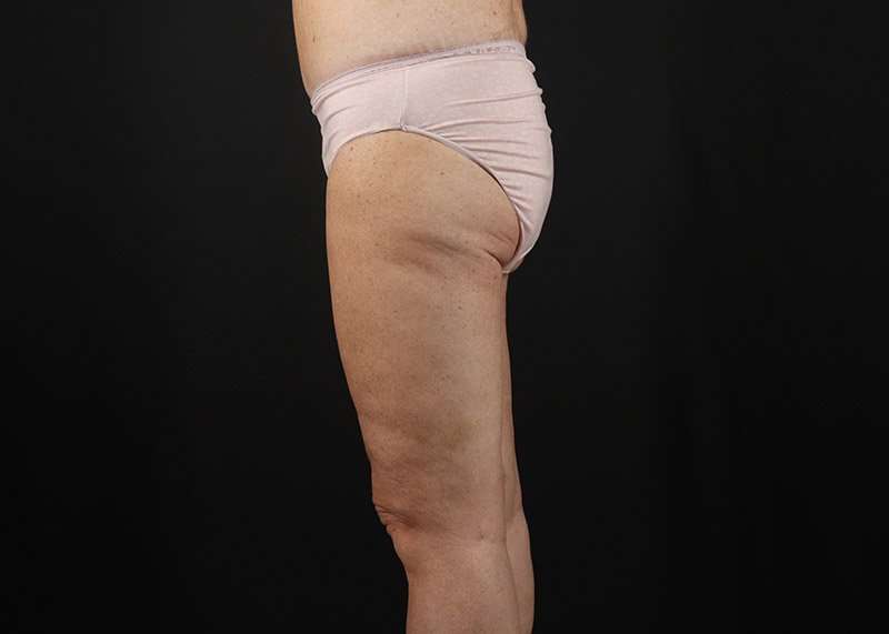 Thigh Lift Before & After Patient #3031