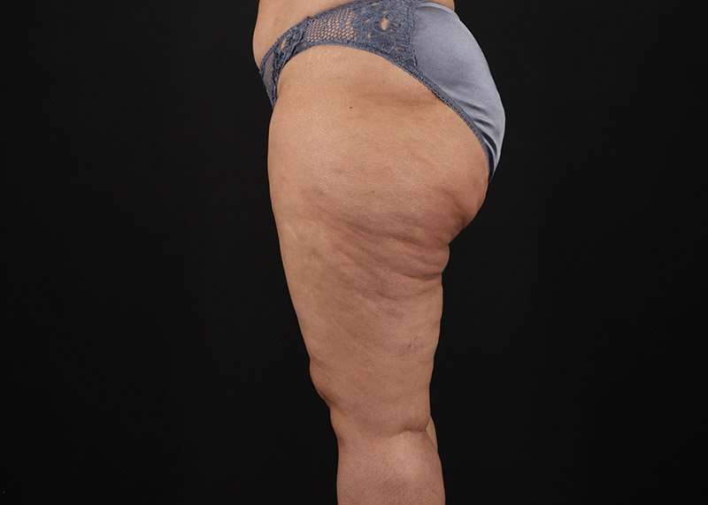 Thigh Lift Before & After Patient #3044