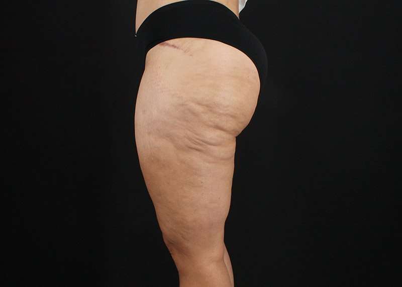 Thigh Lift Before & After Patient #3057