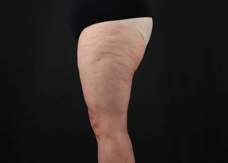 Thigh Lift Before & After Patient #3070