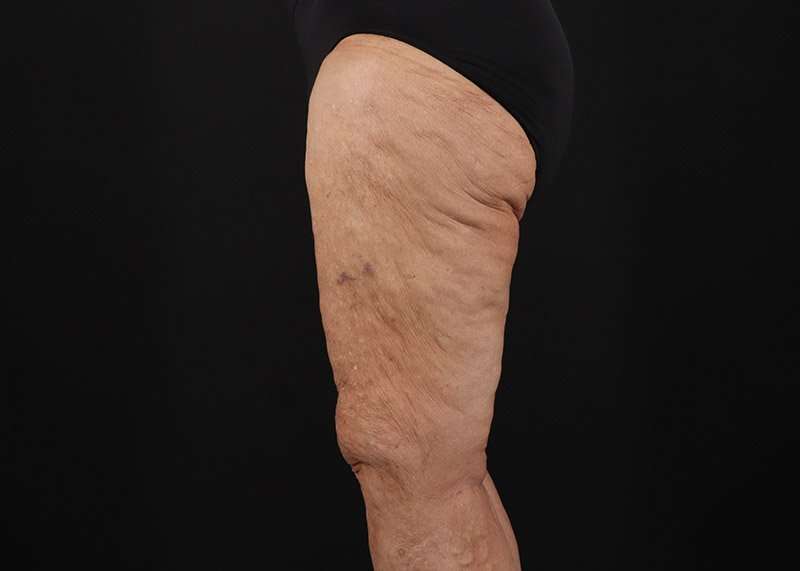Thigh Lift Before & After Patient #3083