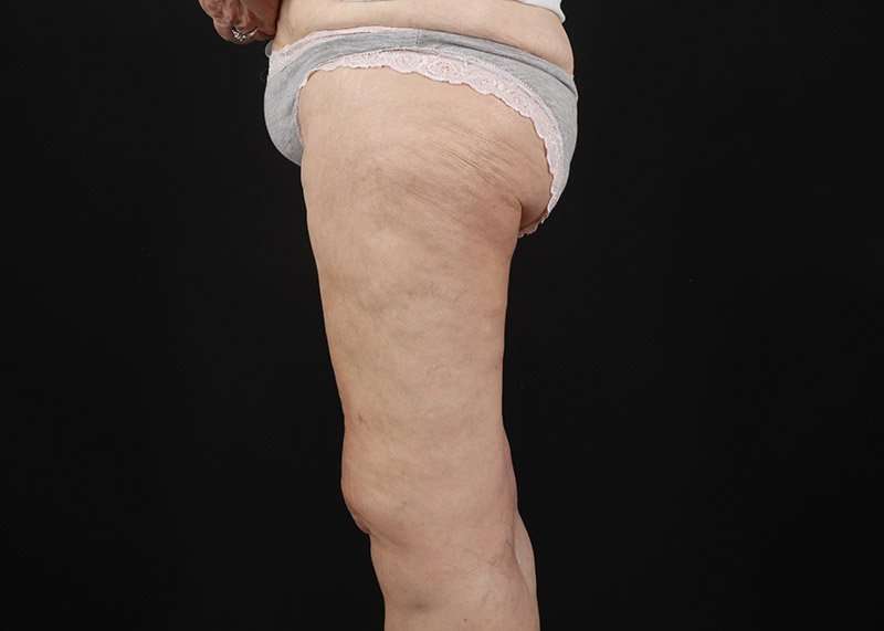 Thigh Lift Before & After Patient #3096