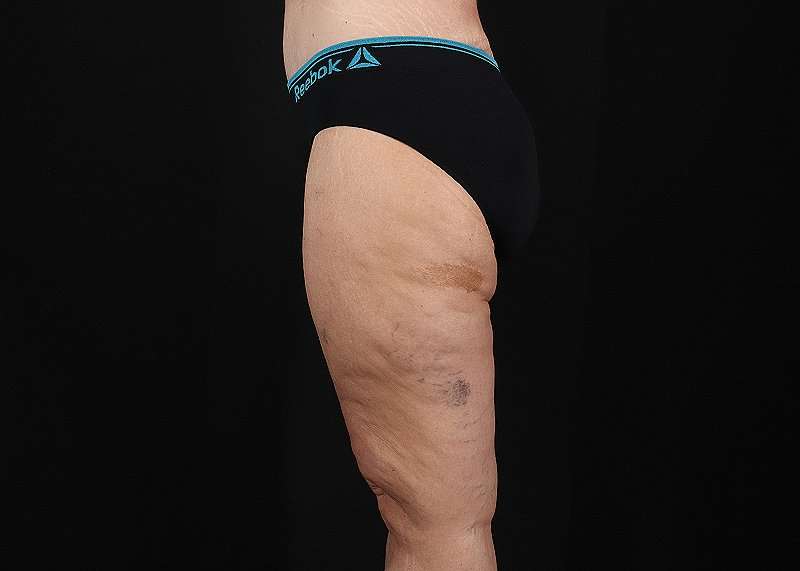 Thigh Lift Before & After Patient #3109
