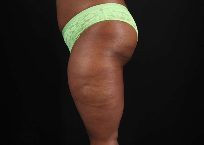 Thigh Lift Before & After Patient #3122