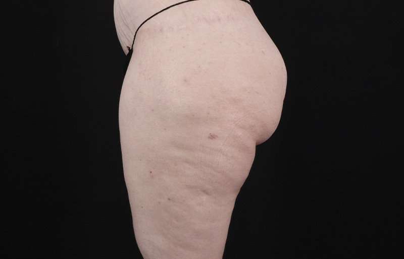 Thigh Lift Before & After Patient #3135