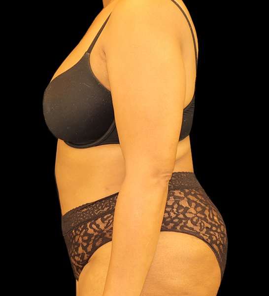 Tummy Tuck Revision Before & After Patient #3146
