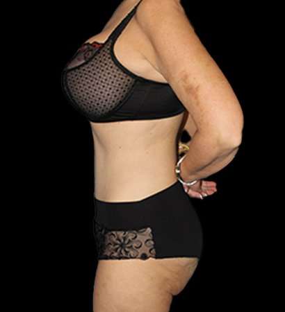 Tummy Tuck Revision Before & After Patient #3168