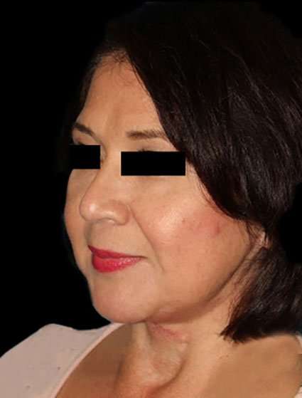 Face & Neck Lift Before & After Patient #3248