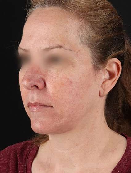 Face & Neck Lift Before & After Patient #3270