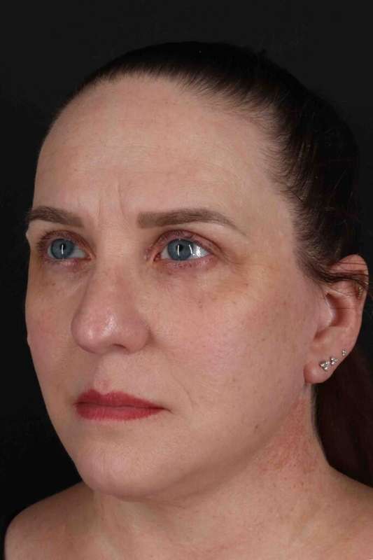 Face & Neck Lift Before & After Patient #3303