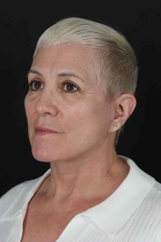 Face & Neck Lift Before & After Patient #3314